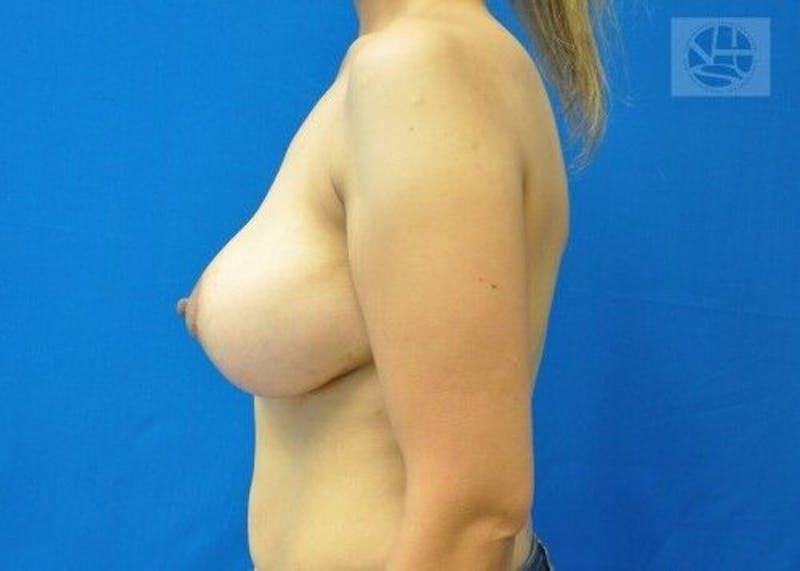 Breast Augmentation with Lift Before & After Gallery - Patient 55345332 - Image 8