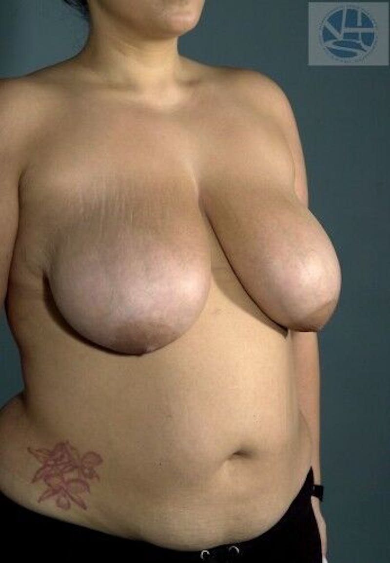 Breast Lift Before & After Gallery - Patient 55345336 - Image 3