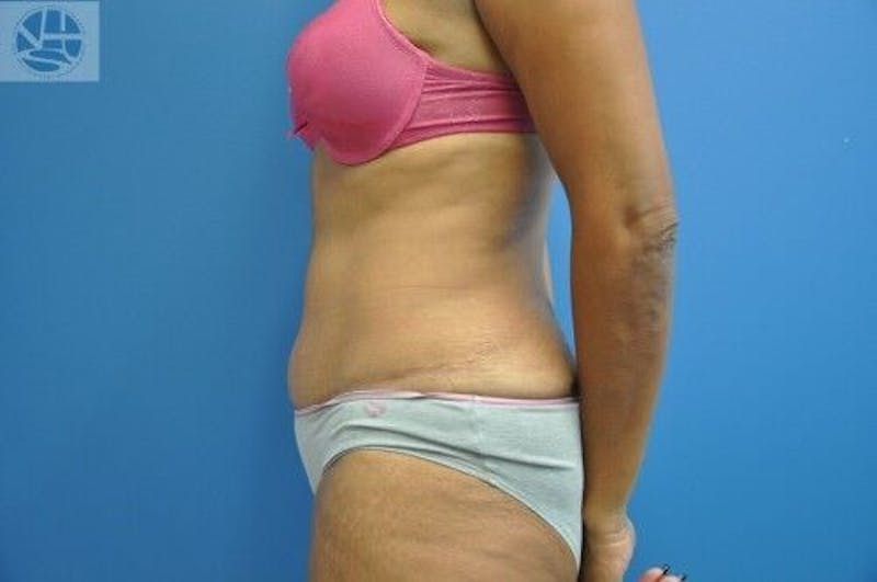 Tummy Tuck Before & After Gallery - Patient 55345333 - Image 8