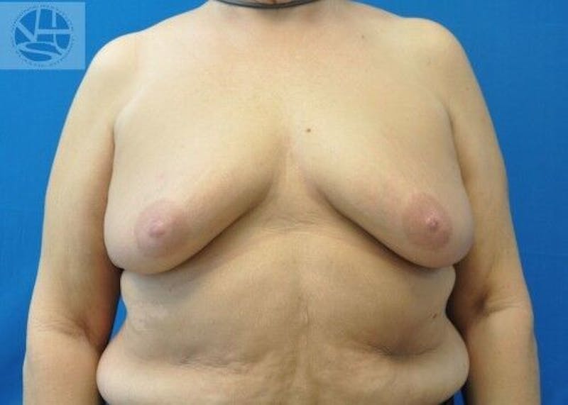 Breast Augmentation with Lift Before & After Gallery - Patient 55345337 - Image 1