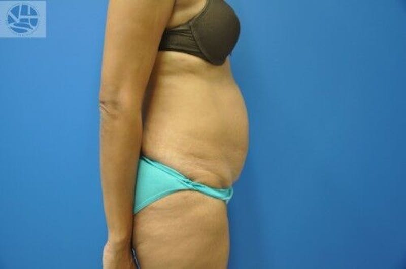 Tummy Tuck Before & After Gallery - Patient 55345333 - Image 9