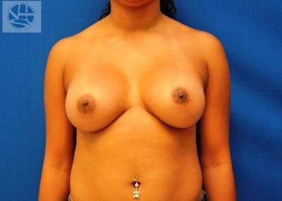 Breast Augmentation Gallery - Patient 55345335 - Image 2