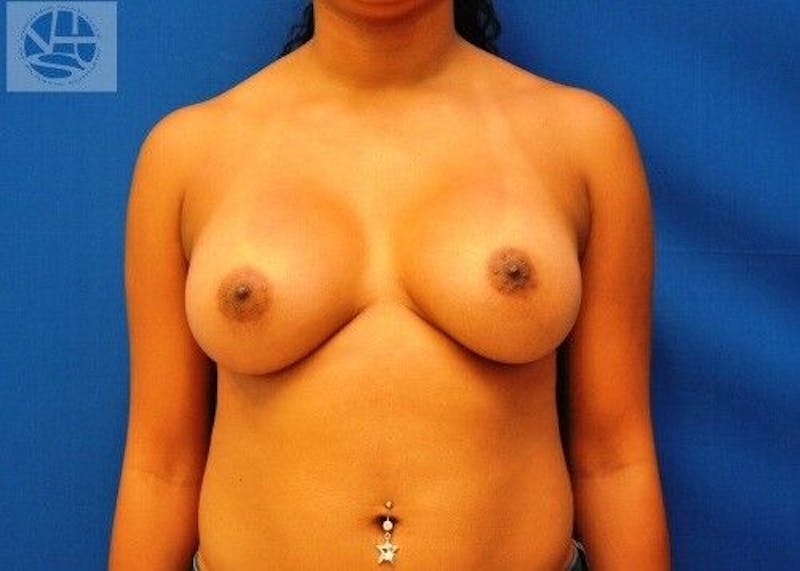 Breast Augmentation Before & After Gallery - Patient 55345335 - Image 2