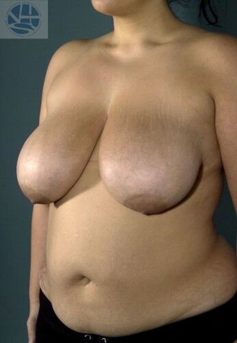Breast Lift Before & After Gallery - Patient 55345336 - Image 5