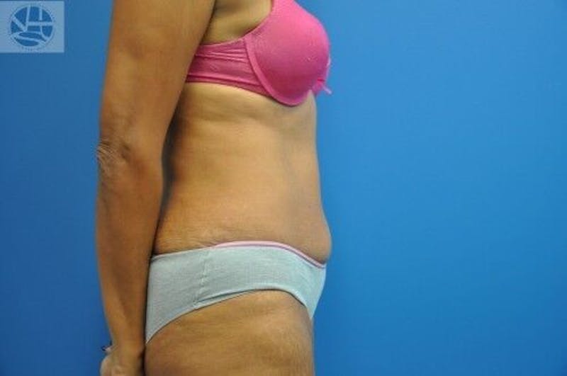 Tummy Tuck Before & After Gallery - Patient 55345333 - Image 10