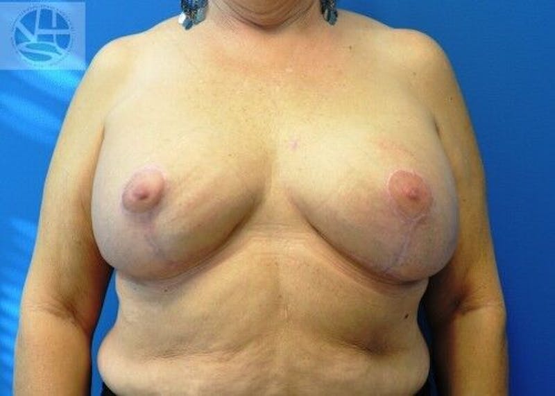 Breast Augmentation with Lift Before & After Gallery - Patient 55345337 - Image 2