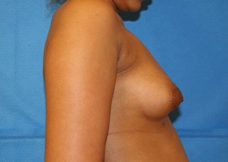 Liposuction Before & After Gallery - Patient 55345334 - Image 5