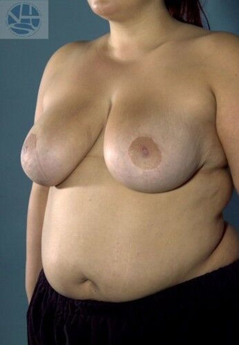 Breast Lift Before & After Gallery - Patient 55345336 - Image 6