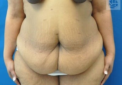 Plus Size Tummy Tuck Before & After Gallery - Patient 389727 - Image 1