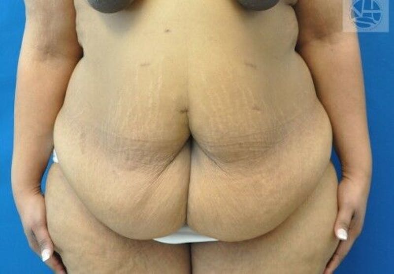 Extended Tummy Tuck Before & After Gallery - Patient 389727 - Image 1