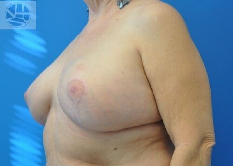 Breast Augmentation with Lift Gallery - Patient 55345337 - Image 4