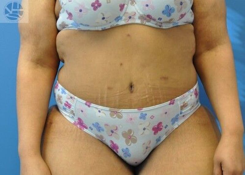 Plus Size Tummy Tuck Before & After Gallery - Patient 389727 - Image 2