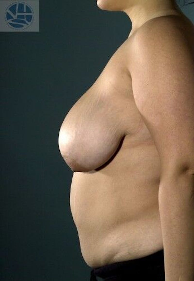 Breast Lift Before & After Gallery - Patient 55345336 - Image 7