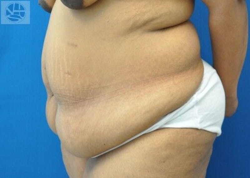 Extended Tummy Tuck Before & After Gallery - Patient 389727 - Image 3
