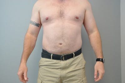 Liposuction Before & After Gallery - Patient 211876592 - Image 2