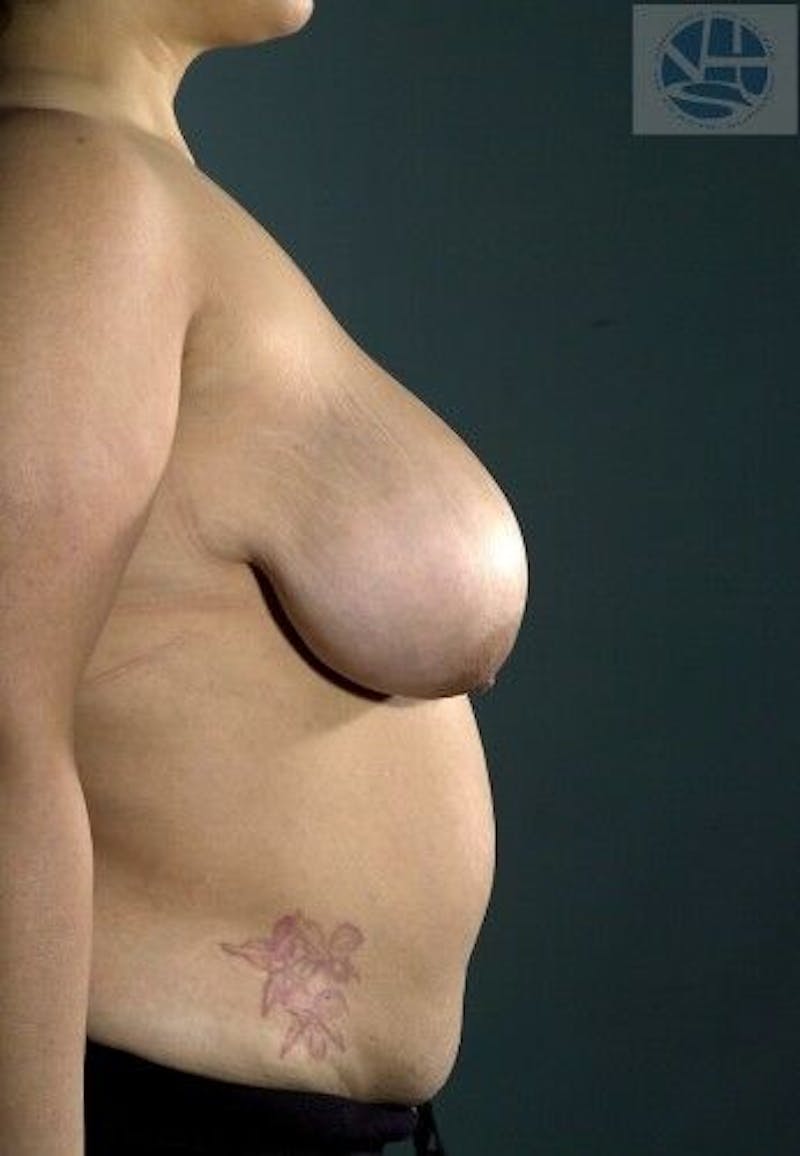 Breast Lift Before & After Gallery - Patient 55345336 - Image 9