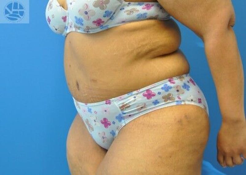 Plus Size Tummy Tuck Before & After Gallery - Patient 389727 - Image 4