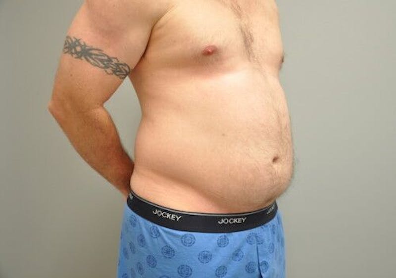 Liposuction Before & After Gallery - Patient 211876592 - Image 3