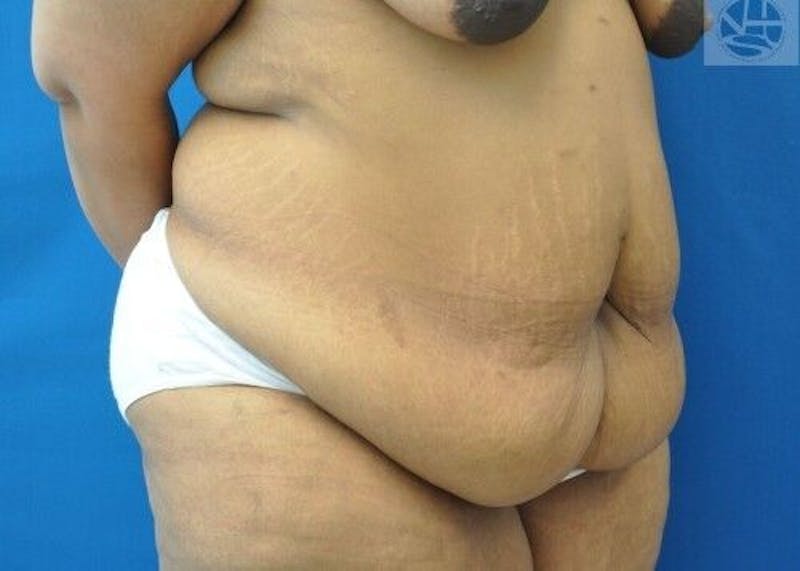Extended Tummy Tuck Before & After Gallery - Patient 389727 - Image 5