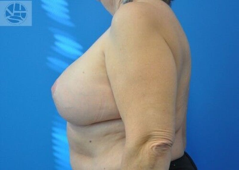 Breast Augmentation with Lift Before & After Gallery - Patient 55345337 - Image 8