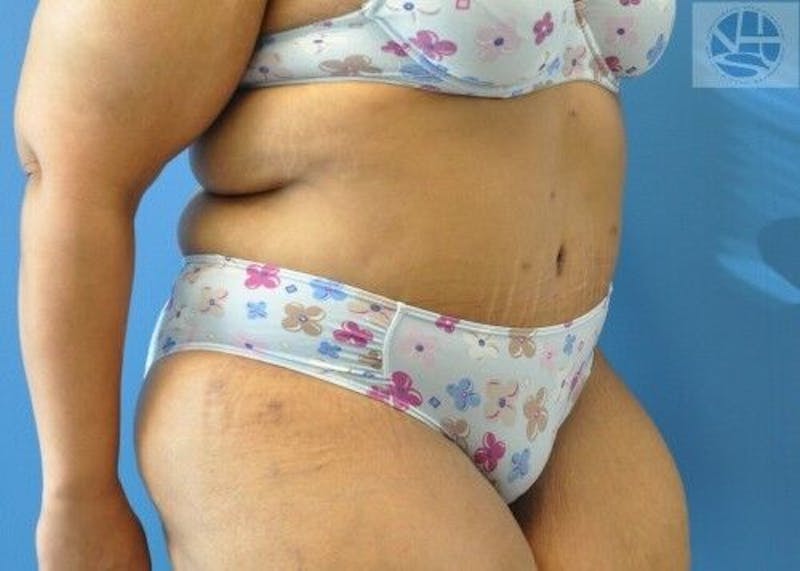 Plus Size Tummy Tuck Before & After Gallery - Patient 389727 - Image 6
