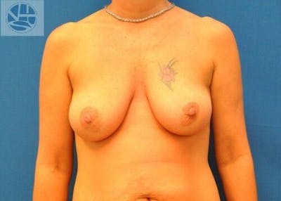 Breast Lift Gallery - Patient 55345340 - Image 1