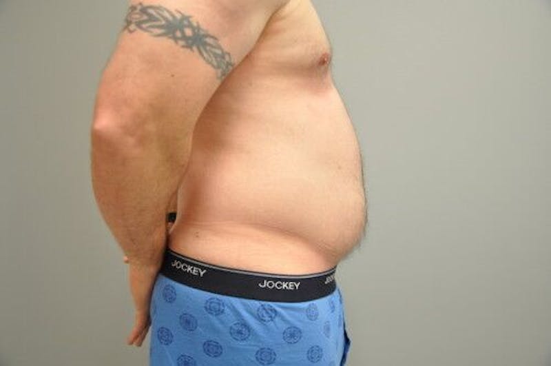 Liposuction Before & After Gallery - Patient 211876592 - Image 5