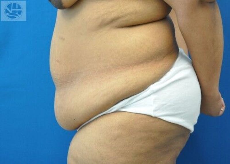 Extended Tummy Tuck Before & After Gallery - Patient 389727 - Image 7
