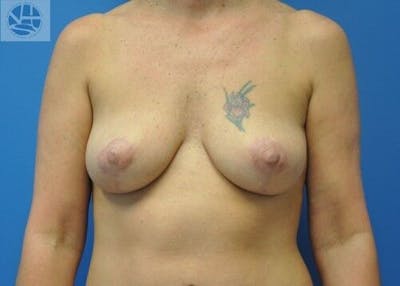 Breast Lift Before & After Gallery - Patient 55345340 - Image 2