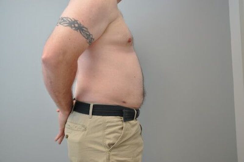 Liposuction Before & After Gallery - Patient 211876592 - Image 6
