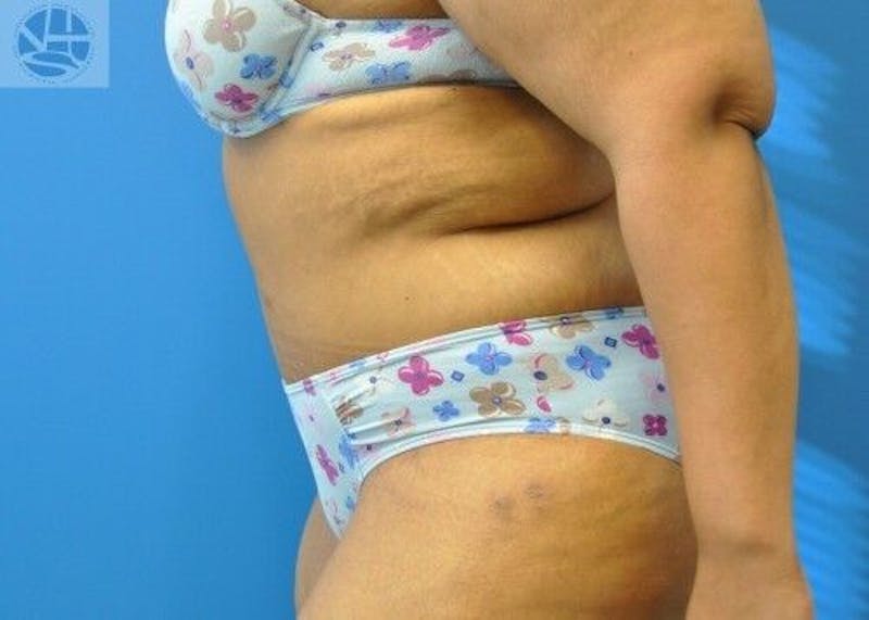 Extended Tummy Tuck Before & After Gallery - Patient 389727 - Image 8