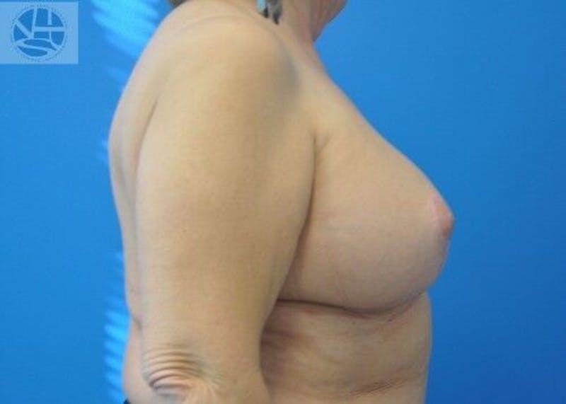Breast Augmentation with Lift Before & After Gallery - Patient 55345337 - Image 10