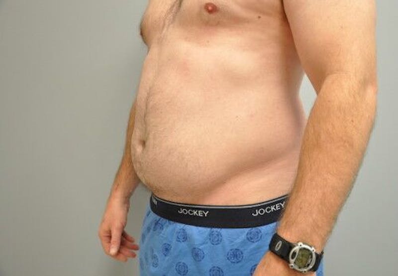 Liposuction Before & After Gallery - Patient 211876592 - Image 7