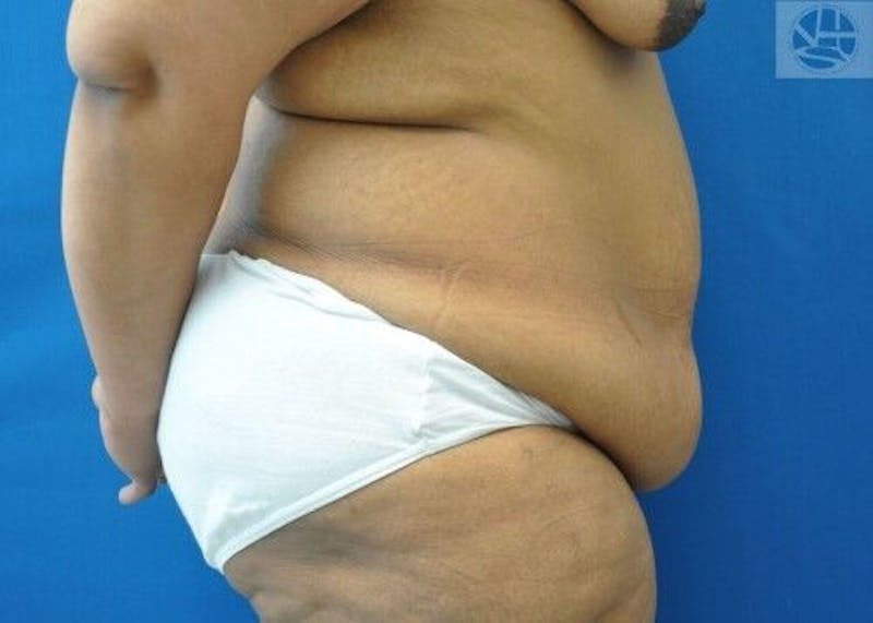 Plus Size Tummy Tuck Before & After Gallery - Patient 389727 - Image 9
