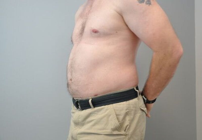 Liposuction Before & After Gallery - Patient 55345341 - Image 8
