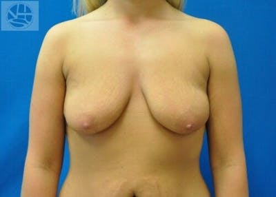 Breast Augmentation with Lift Before & After Gallery - Patient 55345343 - Image 1