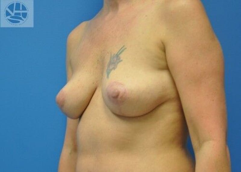 Breast Lift Before & After Gallery - Patient 55345340 - Image 4