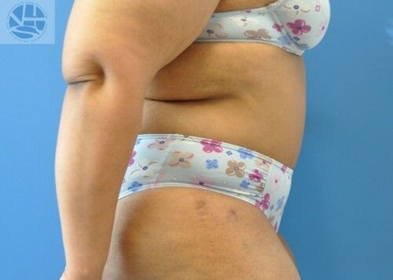 Extended Tummy Tuck Before & After Gallery - Patient 389727 - Image 10
