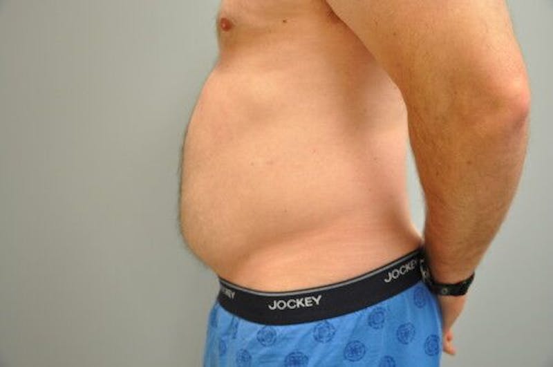 Liposuction Before & After Gallery - Patient 211876592 - Image 9