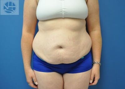 Tummy Tuck Before & After Gallery - Patient 55345345 - Image 1