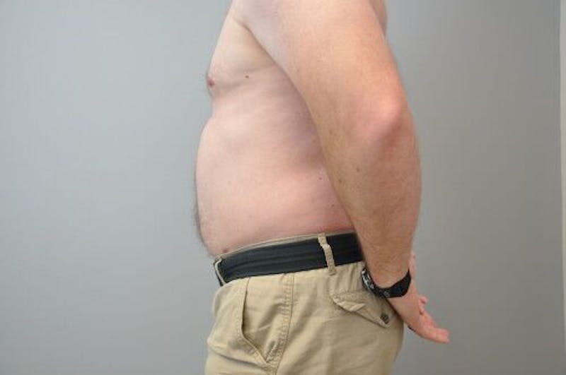 Liposuction Before & After Gallery - Patient 55345341 - Image 10