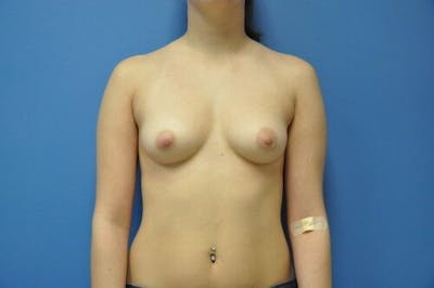 Breast Augmentation Before & After Gallery - Patient 55345344 - Image 1
