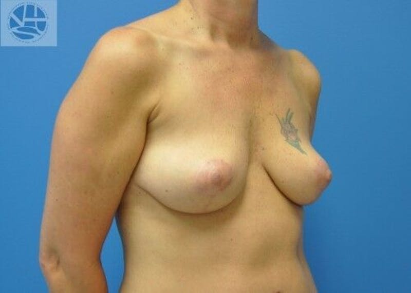 Breast Lift Before & After Gallery - Patient 55345340 - Image 6