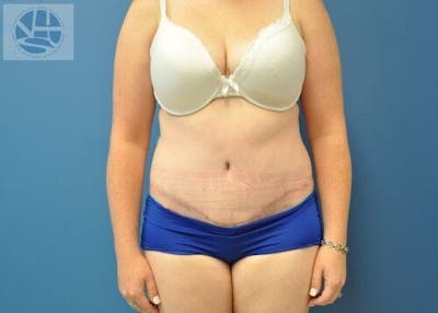 Tummy Tuck Before & After Gallery - Patient 55345345 - Image 2