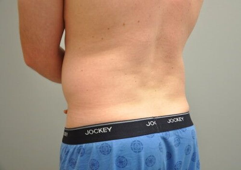 Liposuction Before & After Gallery - Patient 211876592 - Image 11