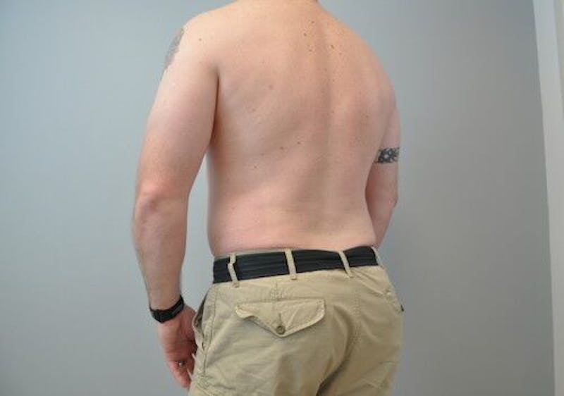 Liposuction Before & After Gallery - Patient 211876592 - Image 12