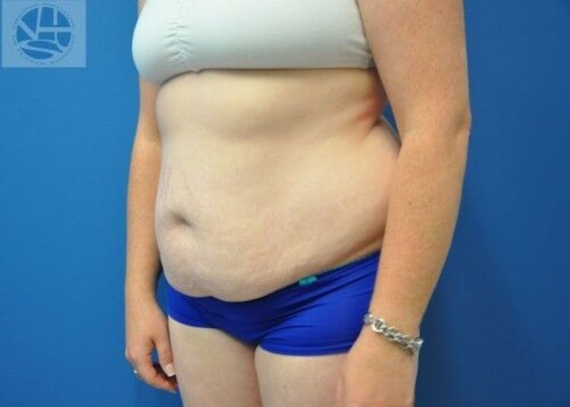 Tummy Tuck Before & After Gallery - Patient 55345345 - Image 3