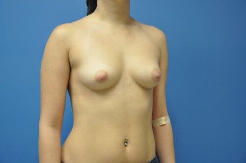 Breast Augmentation Before & After Gallery - Patient 55345344 - Image 3