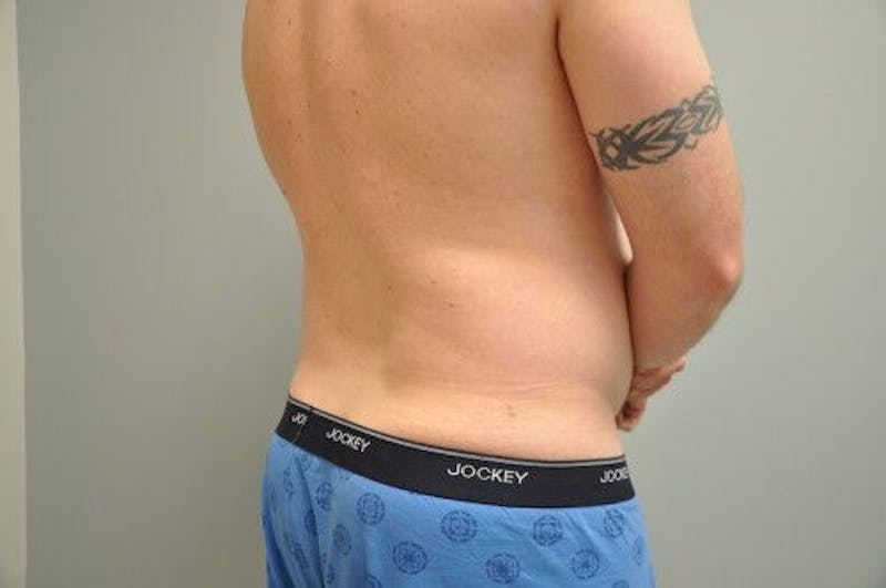 Liposuction Before & After Gallery - Patient 211876592 - Image 13