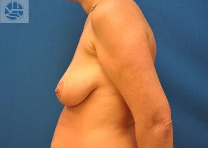 Breast Lift Before & After Gallery - Patient 55345340 - Image 9